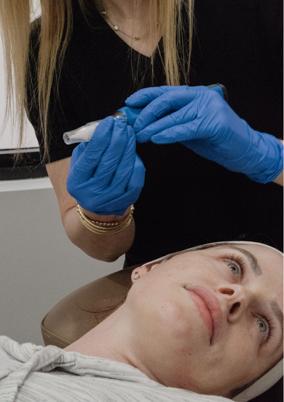 skinpen microneedling treatment davie and broward FL