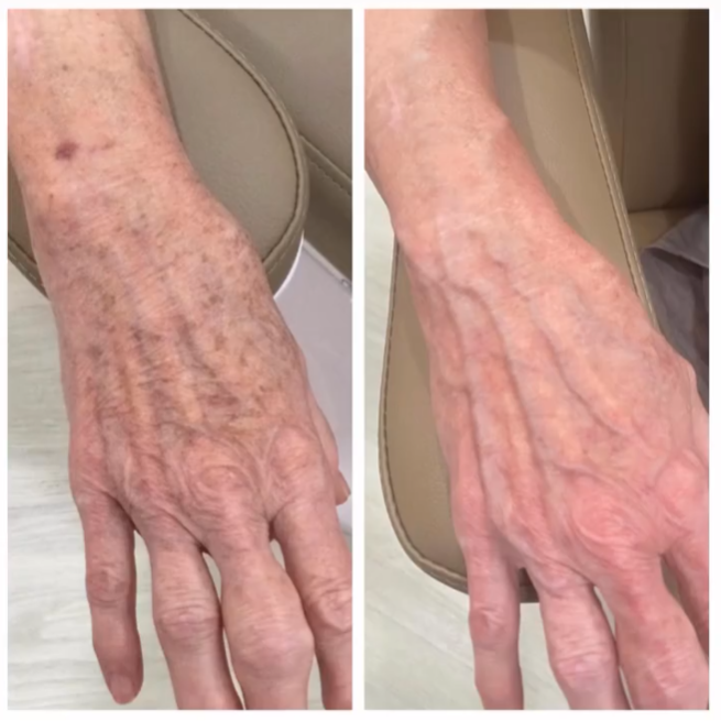 lumecca ipl treatment Davie and Broward FL